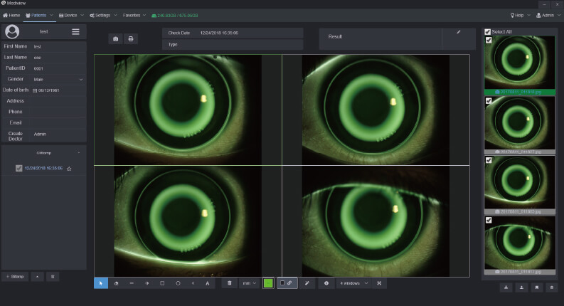 Orthokeratology Lens Fitting